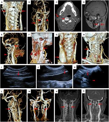 Clinical Classification and Collateral Circulation in Chronic Cerebrospinal Venous Insufficiency